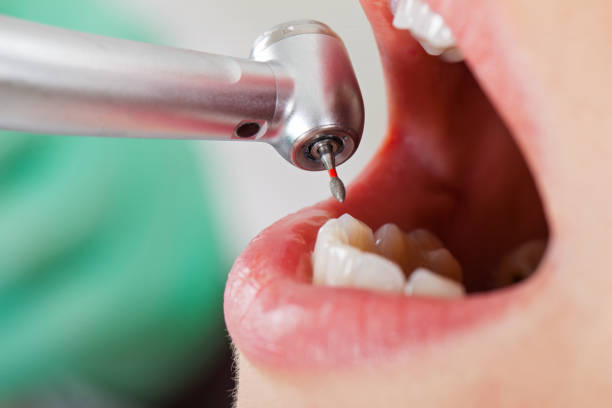 Best Knocked-Out Tooth (Avulsed Tooth) Treatment in Shenandoah Junction, WV